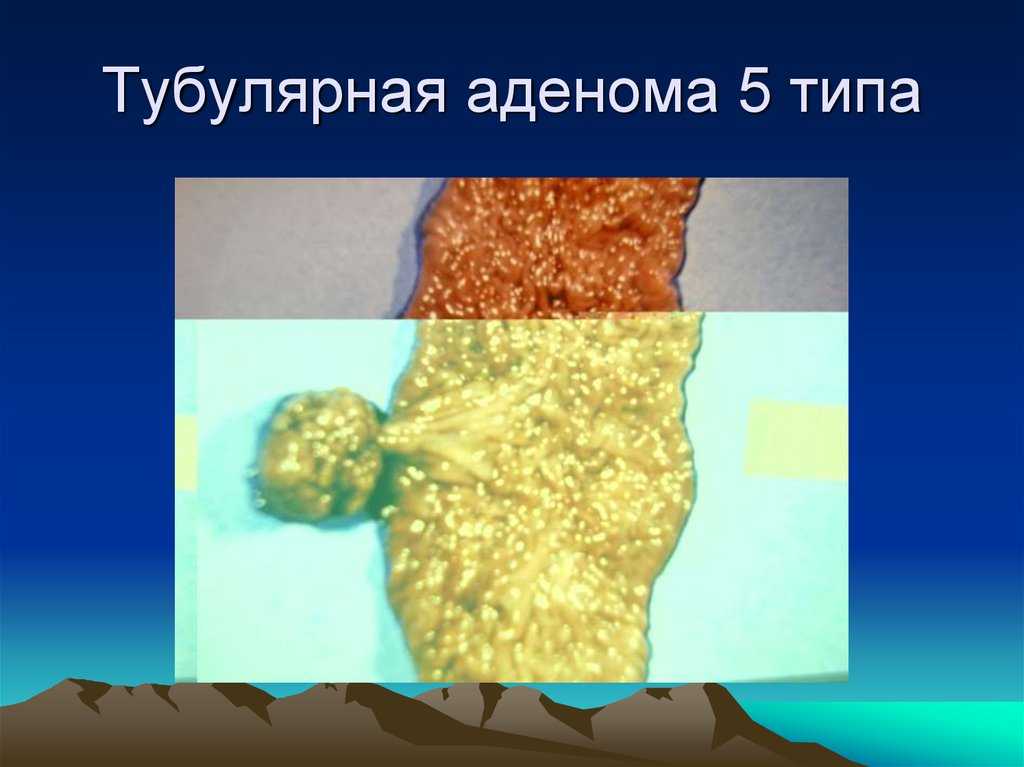 Тубулярная аденома с дисплазией эпителия 1 степени