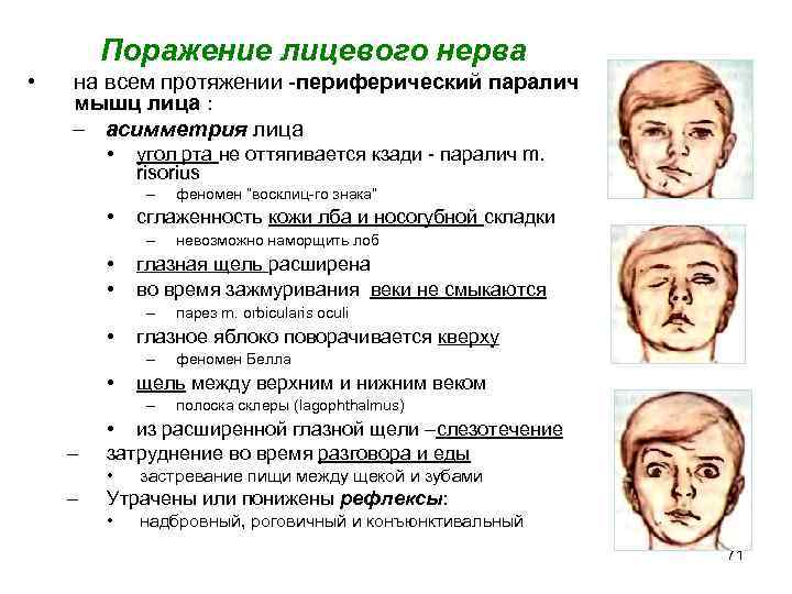 Невропатия лицевого нерва (неврит) ️: симптомы, признаки и причины, диагностика и лечение