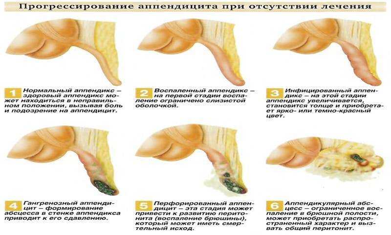 Гангренозный аппендицит: причины и симптомы