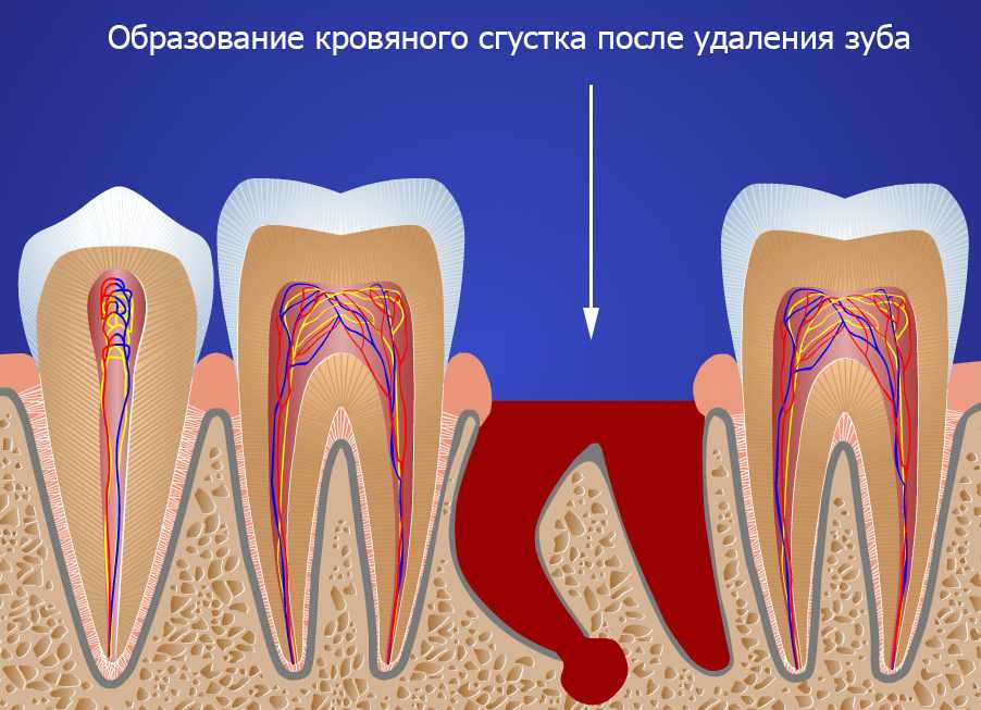 Почему болит зуб после лечения кариеса?