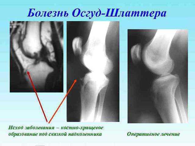 Болезнь осгуда шлаттера у взрослых: последствия, лечение, операция