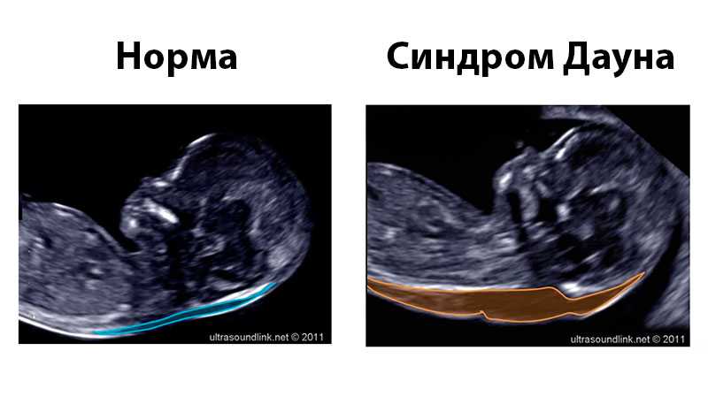 19 неделя беременности: фото живота, вес ребенка и узи