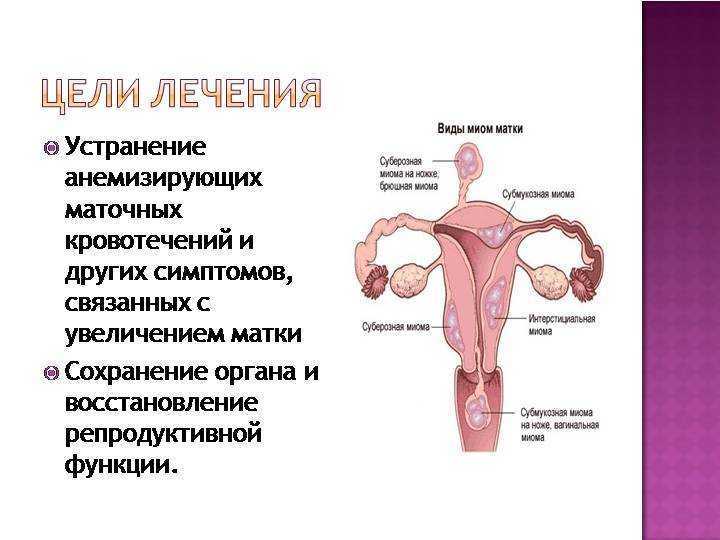 Интерстициальная миома матки: удаление, размеры