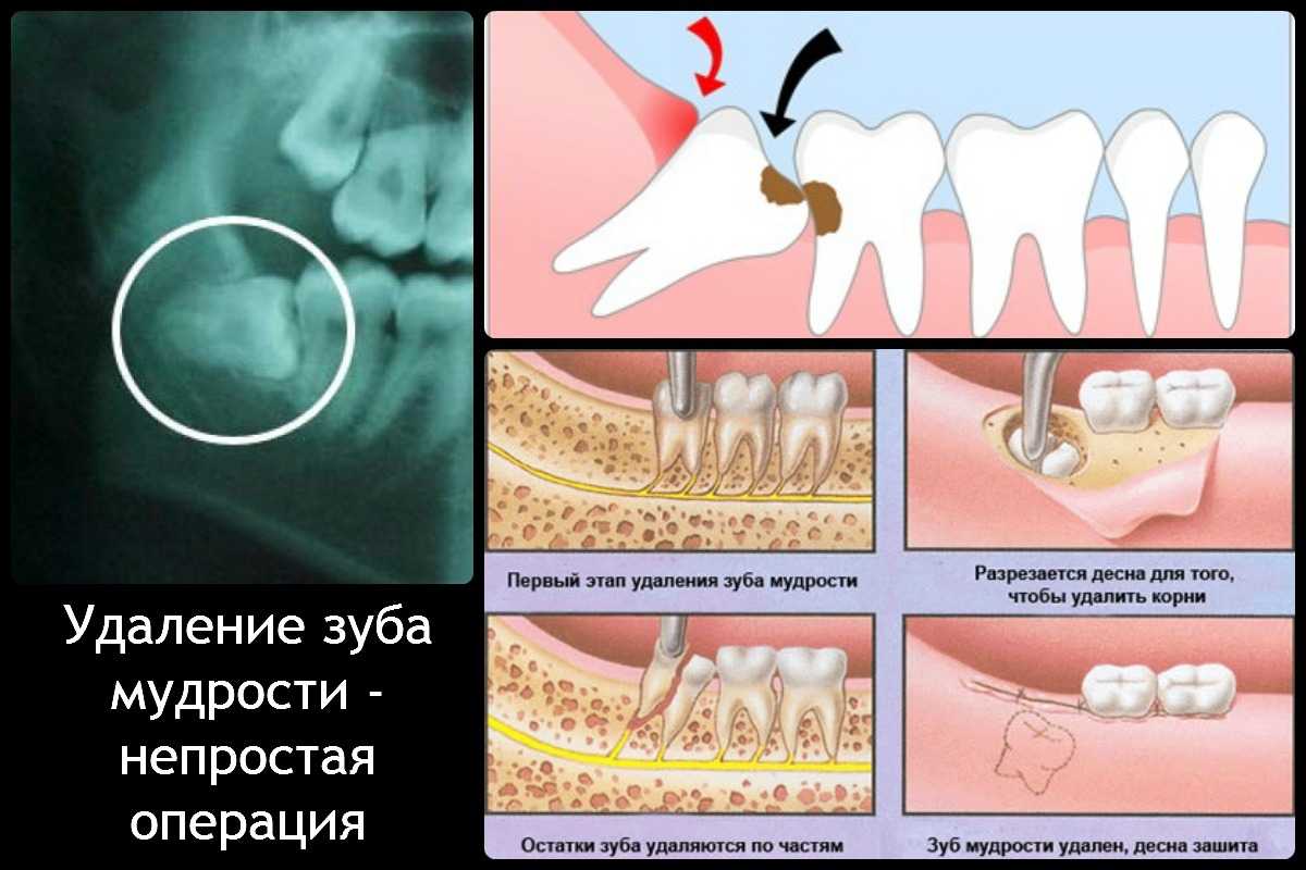 Перикоронит зуба мудрости