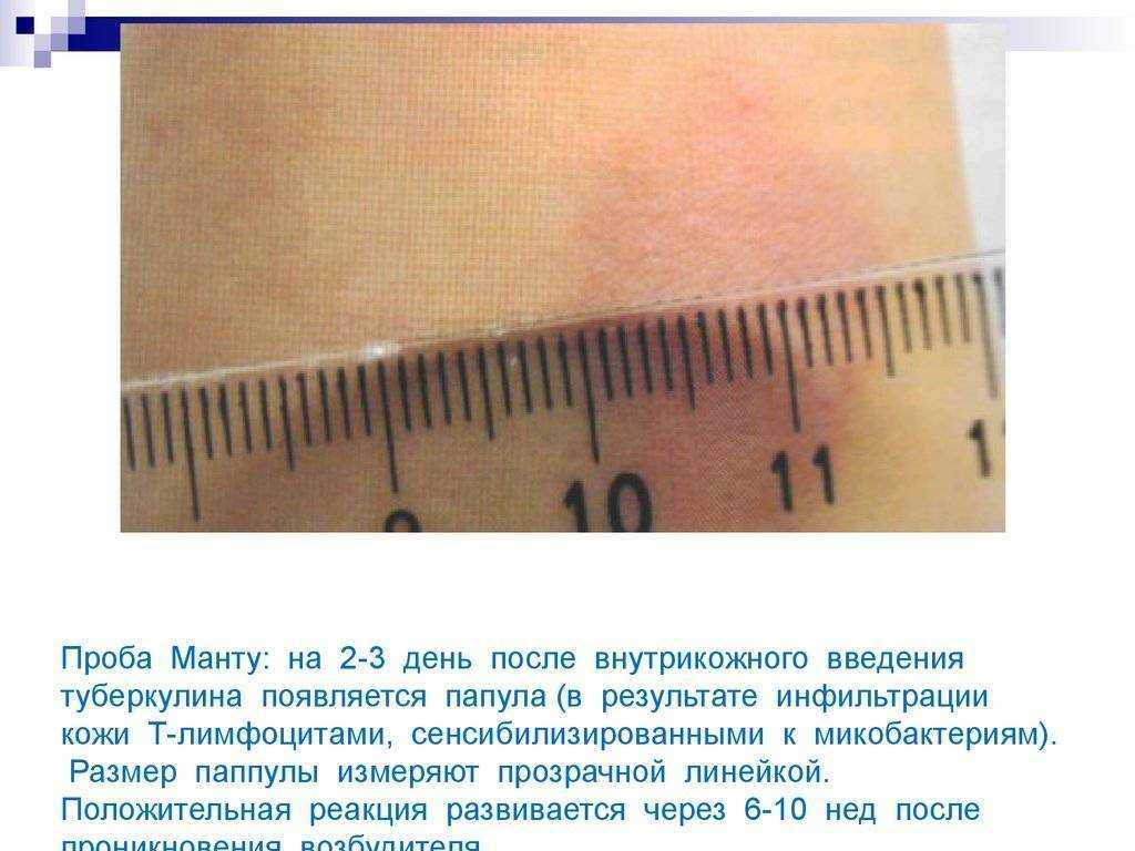Проведение пробы манту
