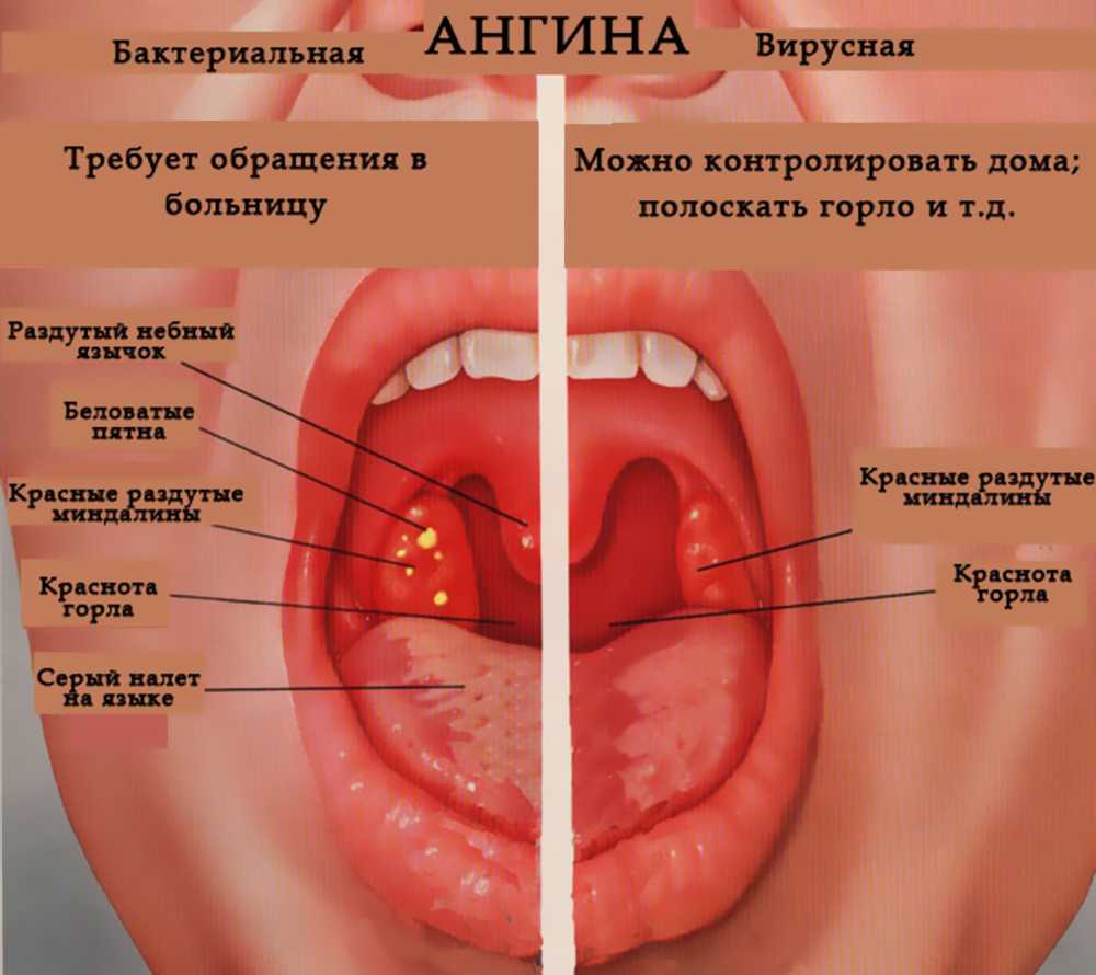 Острый тонзиллит (ангина): признаки, лечение
