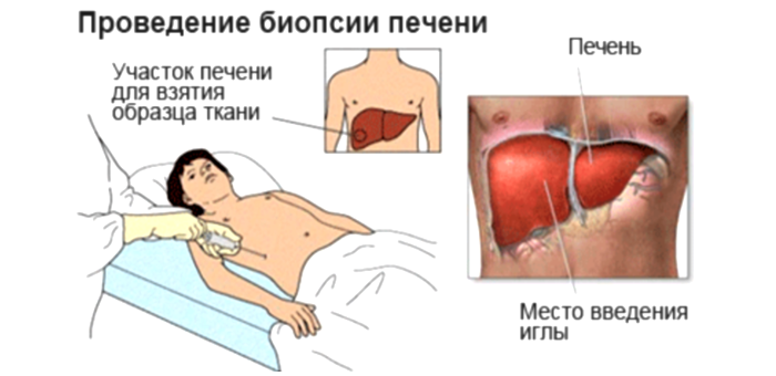 Биопсия печени