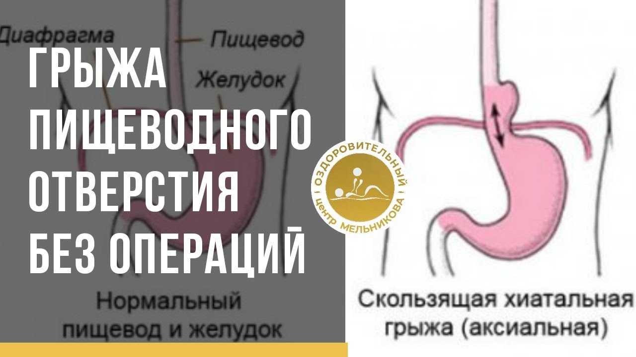 Причины, симптомы и лечение аксиальной грыжи пищеводного отверстия диафрагмы