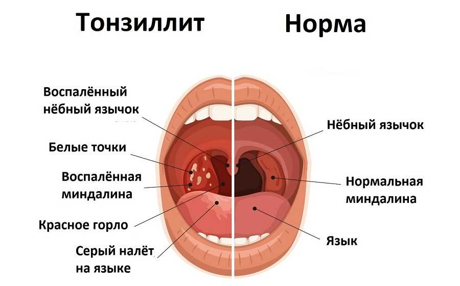 Удаление миндалин у взрослых – так ли это необходимо? - белая клиника