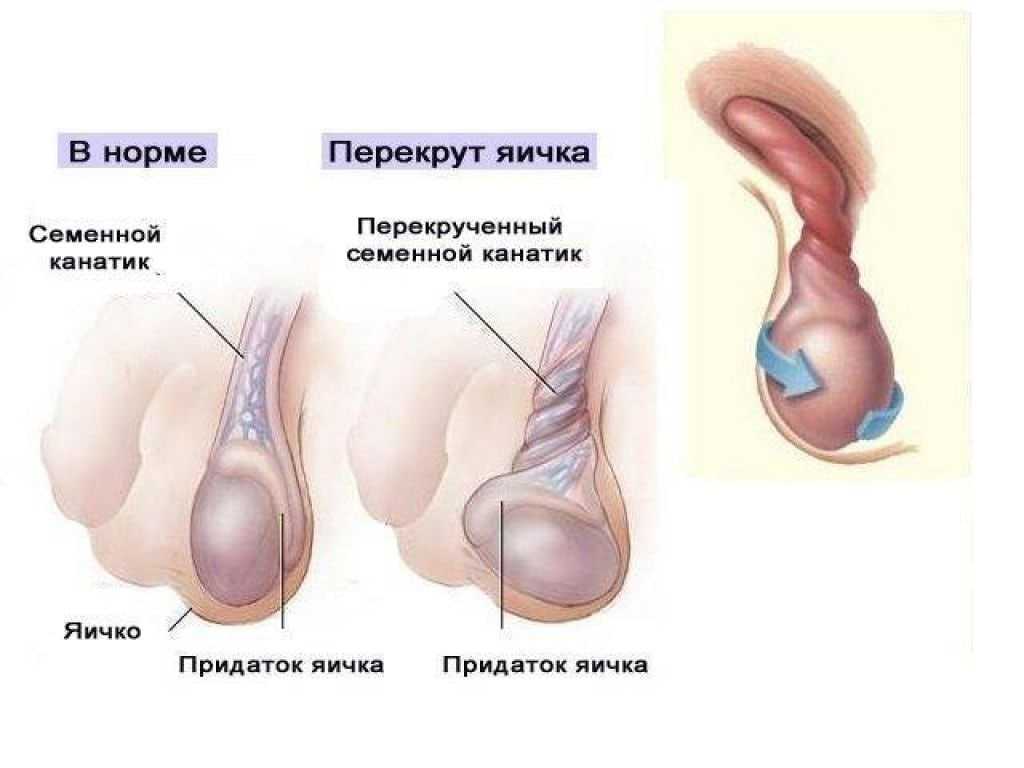 Орхиэктомия (удаление яичка у мужчин): показания, последствия, послеоперационный период