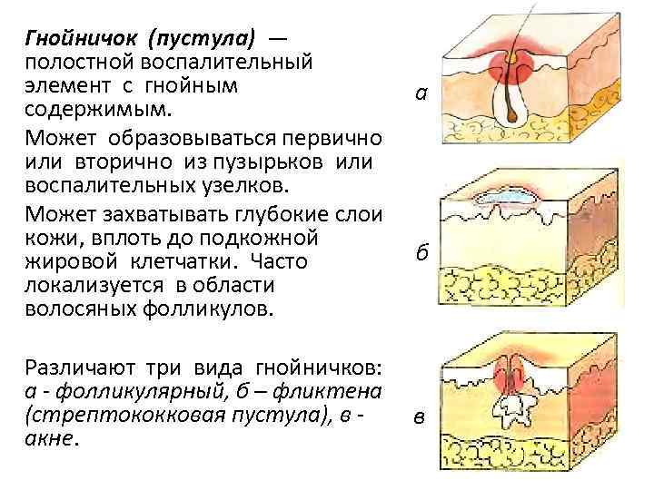Бактериальные инфекции кожи у детей