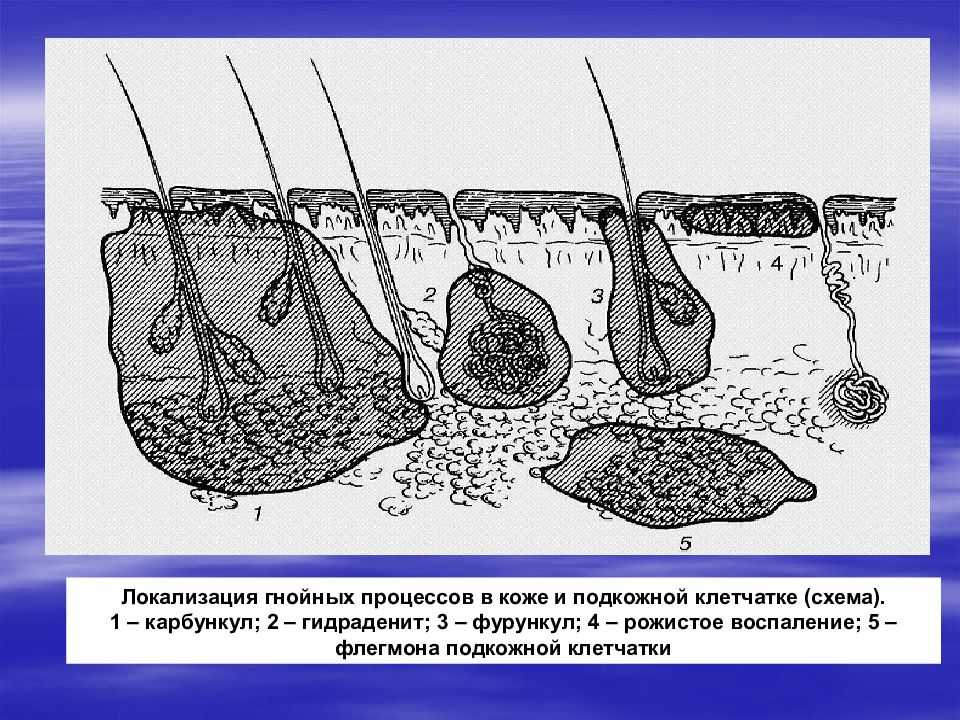 Отличия фурункула от карбункула: в чем разница?