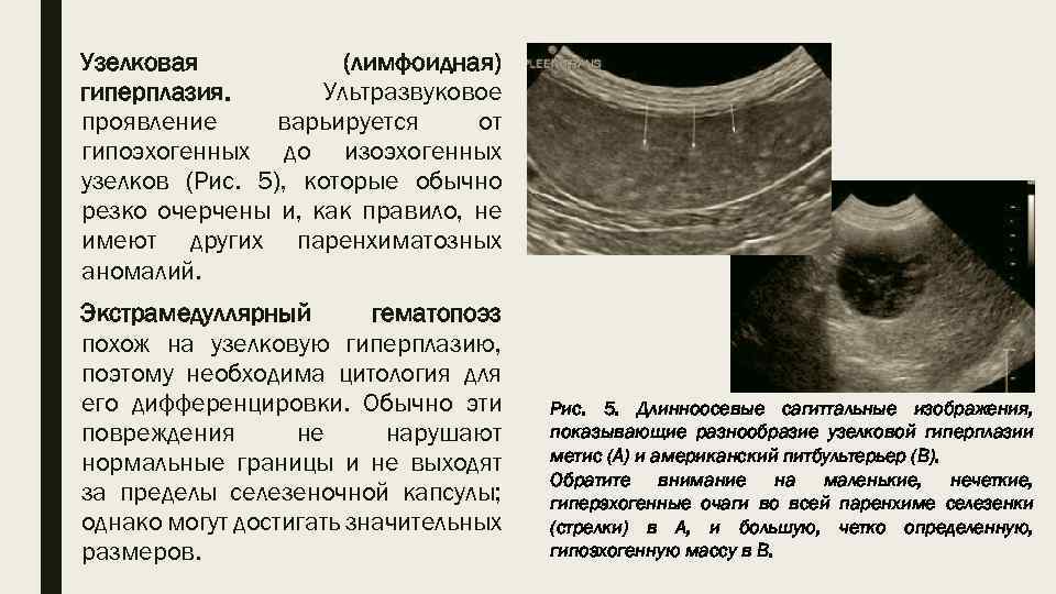 Лимфофолликулярная гиперплазия антрального отдела желудка лечение. лимфоидная гиперплазия кишечника
