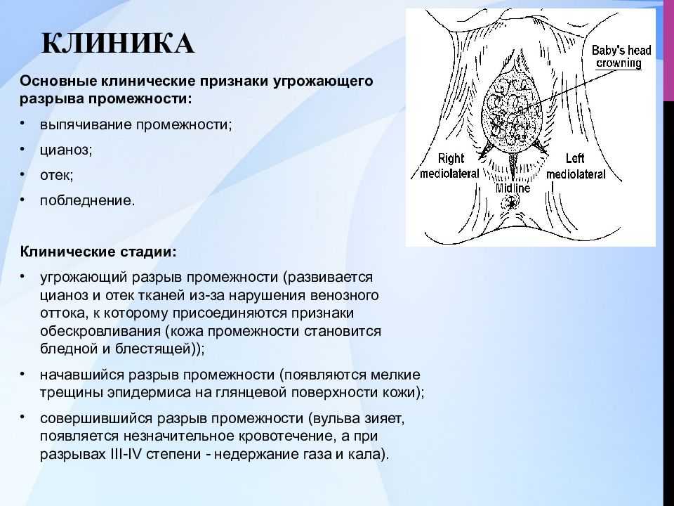 Эпизиотомия