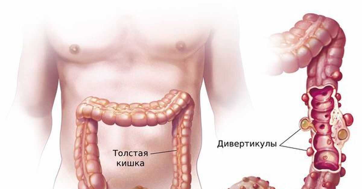 Дивертикулярная болезнь толстой кишки