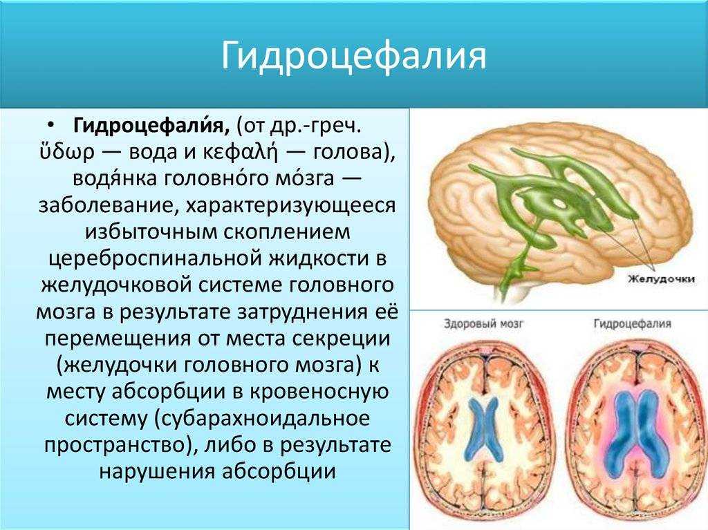 Гидроцефалия: что это такое?