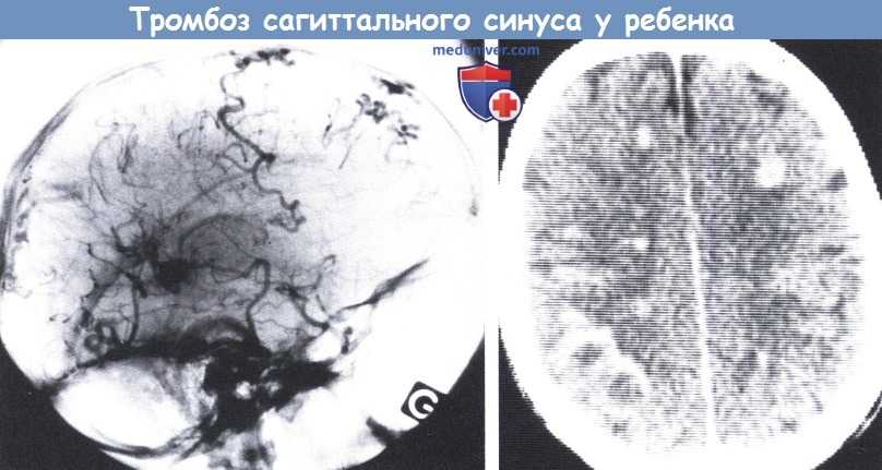 Синус тромбоз головного мозга - лечение, симптомы, причины