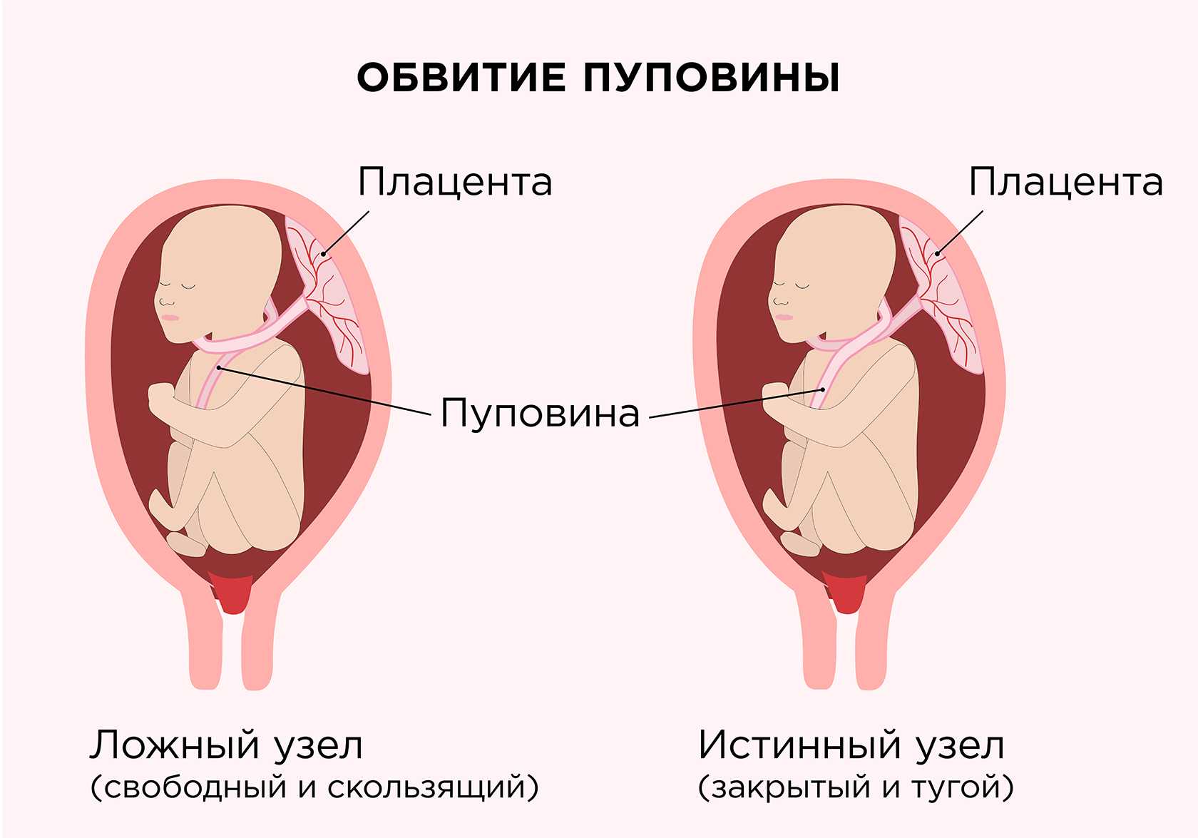Обвитие пуповиной вокруг шеи плода: последствия, роды при однократном и двойном обвитии