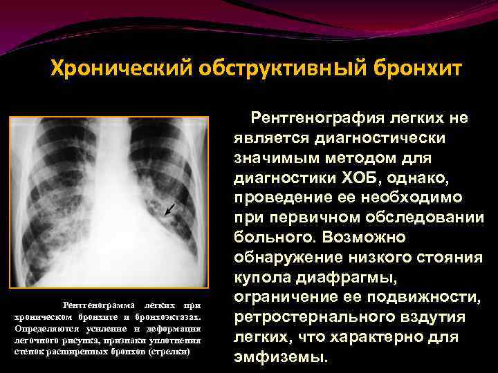 Темное пятно на ребре. пятна на лёгких при рентгене: какие могут быть причины? что обнаруживает на снимке рентгенолог