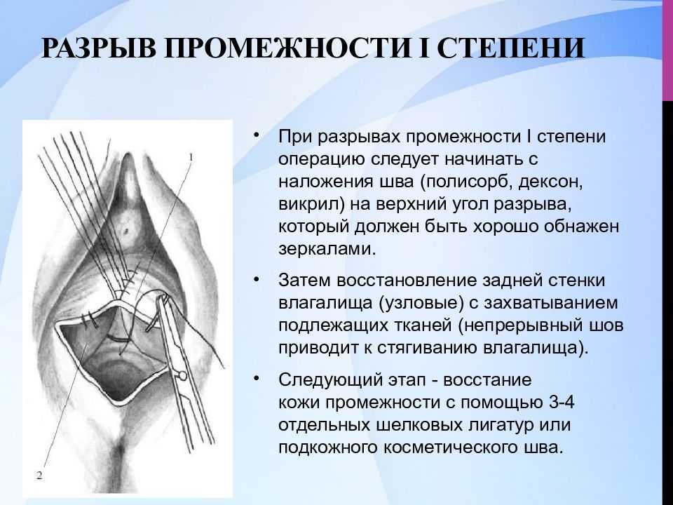 Эпизиотомия и швы :-( - страна мам