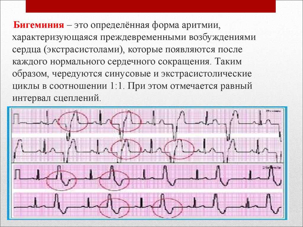 Бигеминия как разновидность внеочередных сокращений  Желудочковая бигеминия: что это такое и как лечить  Аритмии относят к числу самых распространенных
