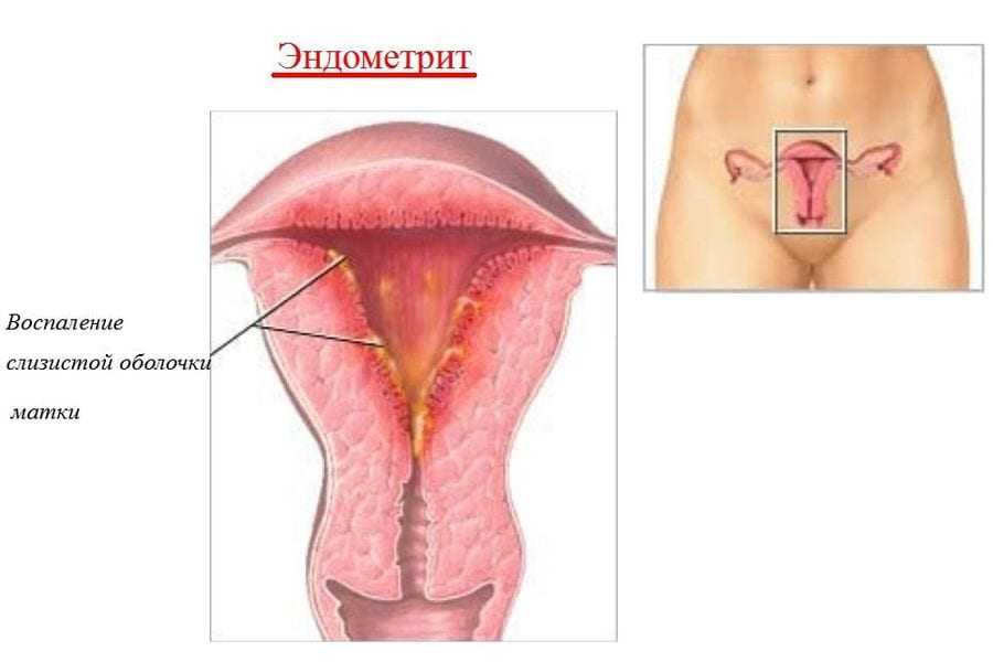 Эндометрит у женщин: 8 причин, 3 варианта лечения, послеродовой