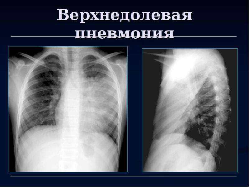 Левосторонняя верхнедолевая и нижнедолевая пневмония у взрослых и детей симптомы, лечение