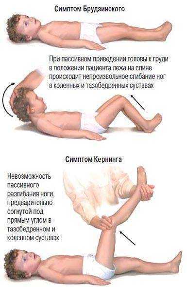 Как распознать симптомы менингита (с иллюстрациями)