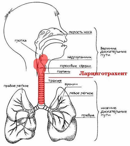 Острый обструктивный ларингит (круп)
