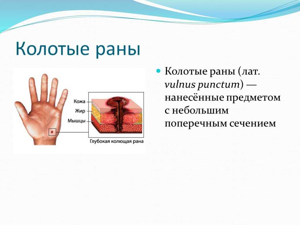 Резаные раны — судебно-медицинская энциклопедия