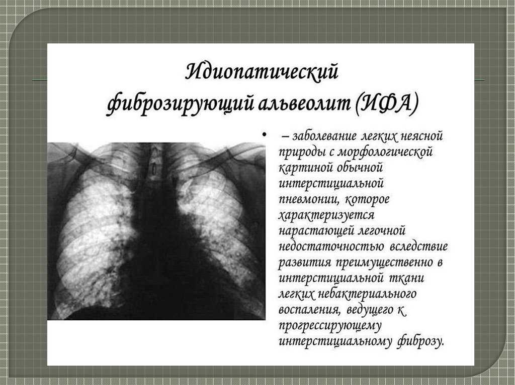 Альвеолит - почему возникает, диагностика и как лечить - много зубов