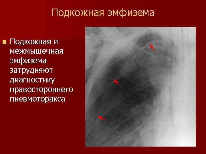 Подкожная эмфизема грудной клетки: причины, лечение и возможные осложнения