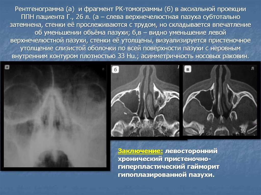 Хронический верхнечелюстной синусит, лечение гиперпластического двустороннего верхнечелюстного синусита