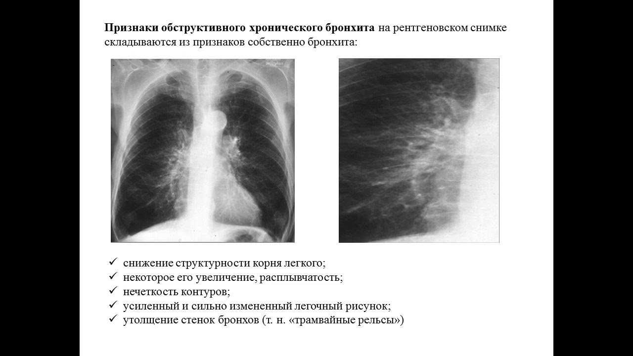 Затемнения в легких на рентгене