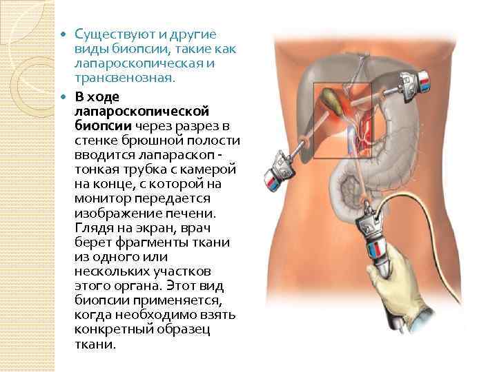 Биопсия печени в германии