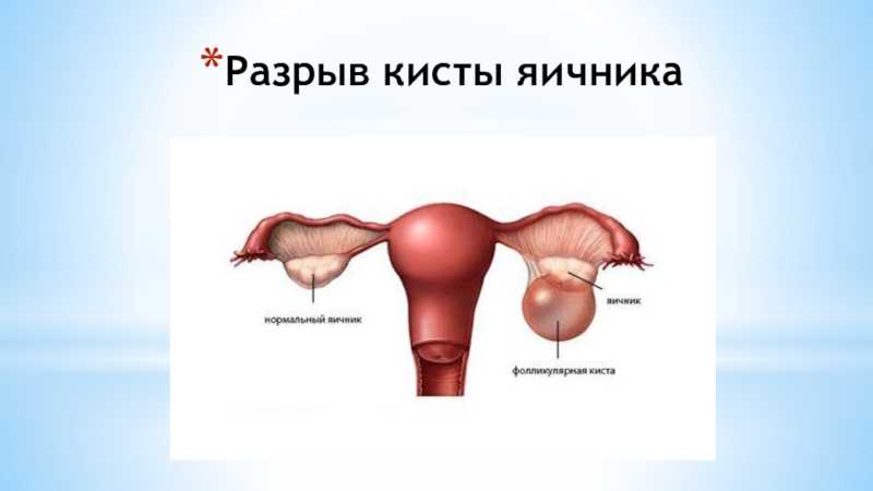Лечение и причины разрыва кисты желтого тела  Разрыв желтого тела яичника  Киста желтого тела – достаточно часто диагностируемое гинекологическое
