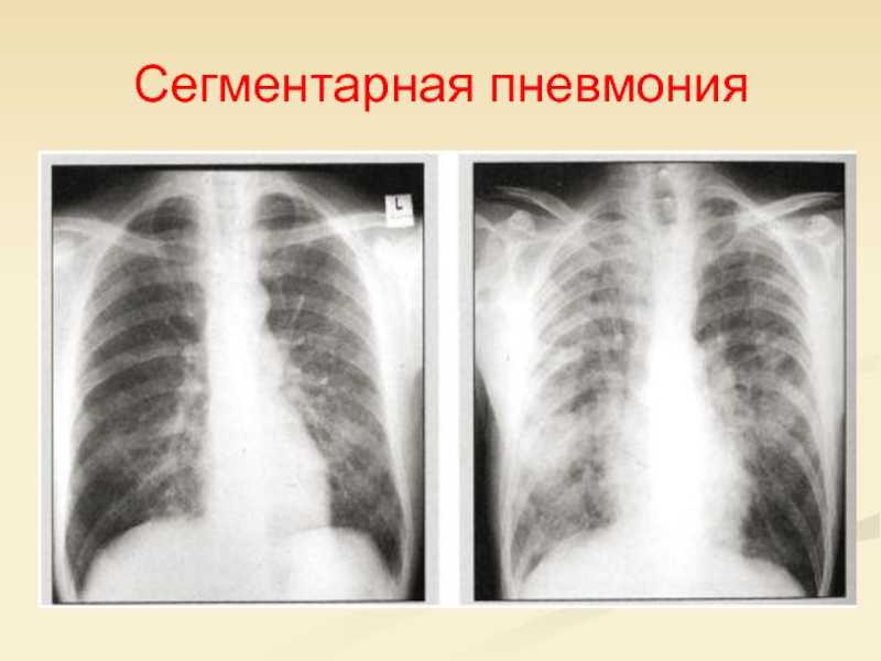 Все о сегментарной пневмонии у детей и полисегментарной  Каково преимущество дифференциальной диагностики  Все о сегментарной пневмонии у детей  Каково