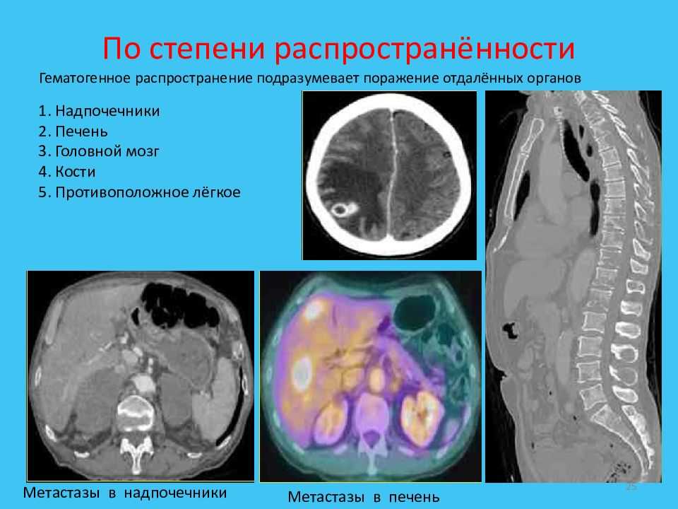 Рак легких (1,2,3,4 стадия) 8 симптомов перед смертью, сколько живут?