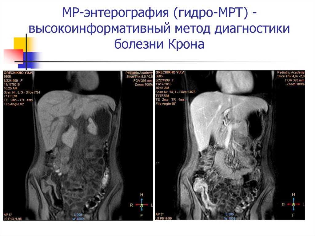Диета перед колоноскопией кишечника, что можно есть, безшлаковая диета, вкусное и полезное меню