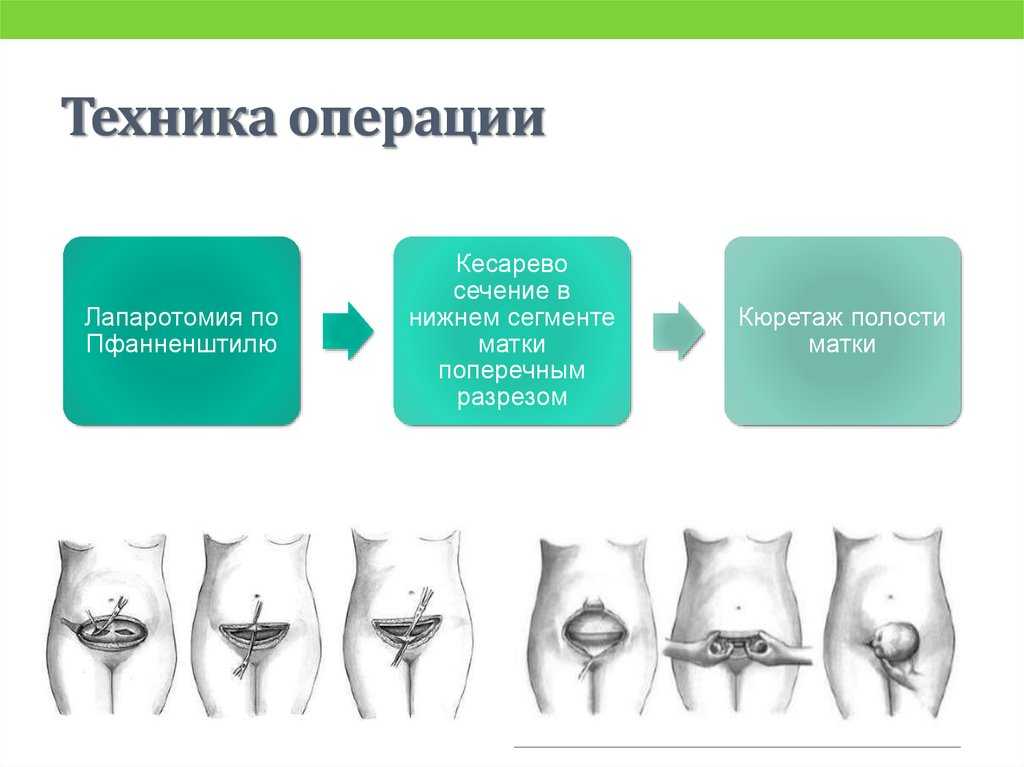 Роды без боли: подготовка.