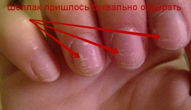 Наращивание ногтей при беременности