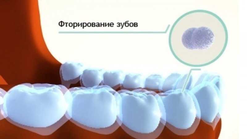 Эффективные способы фторирования зубов после чистки? | зубы
как осуществляется фторирование зубов после чистки? | зубы