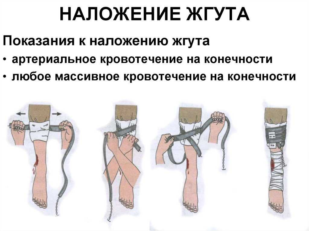 Оказание первой помощи при кровотечениях: правила наложения жгута