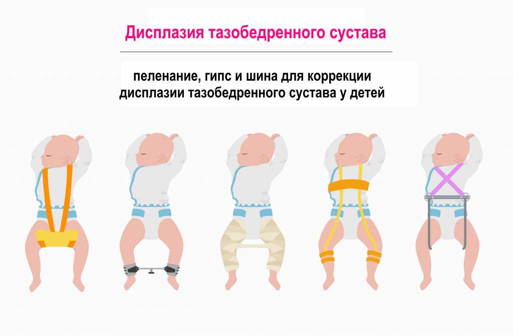 Дисплазия тазобедренных суставов у ребенка - лечение