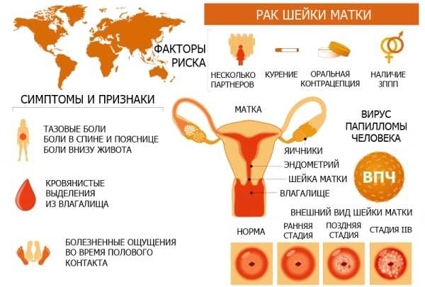 Рак шейки матки: симптомы, лечение – напоправку