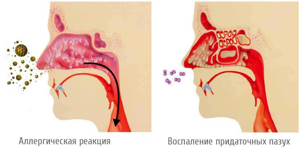 У ребенка сопли с кровью при насморке: причины, сопутствующие симптомы, лечение