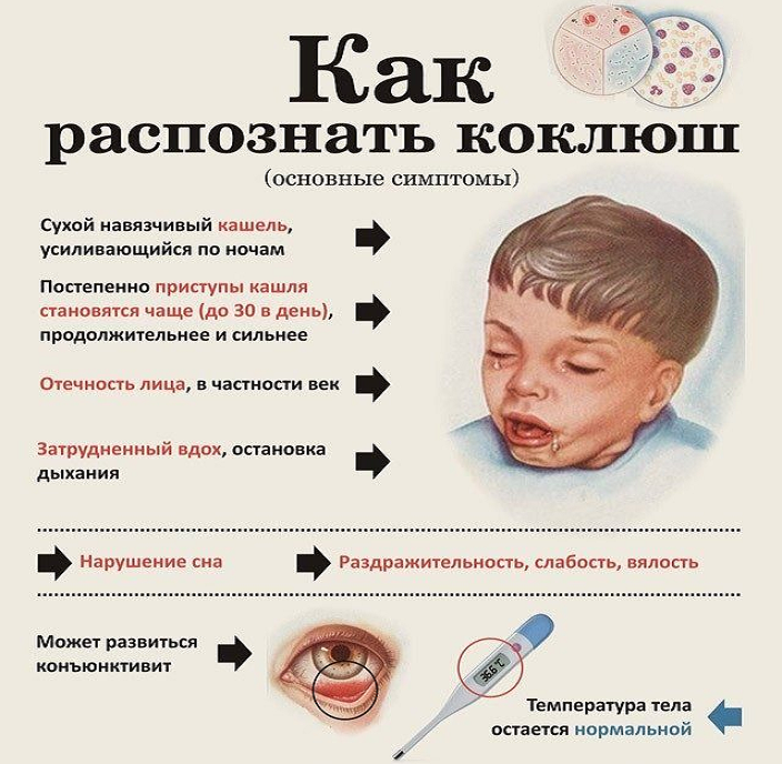Коклюш: диагностика, симптомы, лечение – напоправку – напоправку