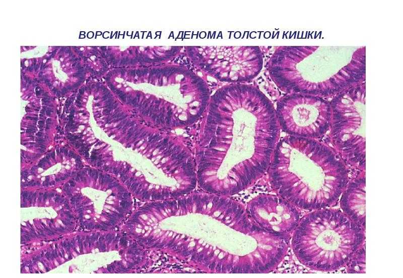 Тубулярная аденома — виды, причины, симптомы и удаление