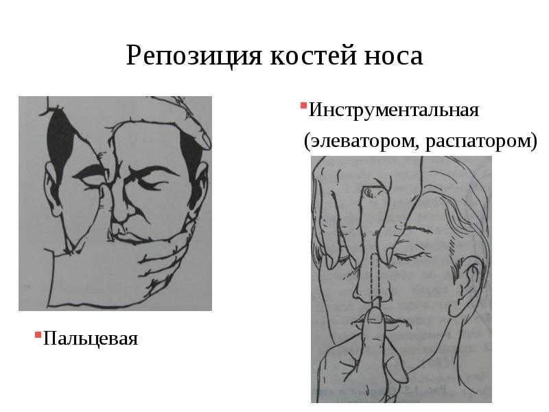 Нос сломан со смешениями, проведение репозиции при переломе | glory skin