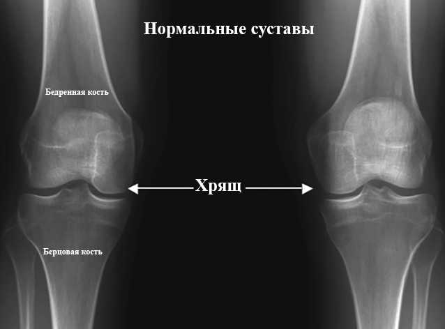 Рентген коленного сустава: что показывает снимок в двух проекциях, как делают